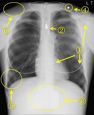 胸部レントゲン写真3