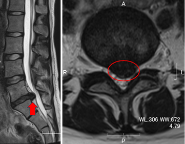 術前MRI