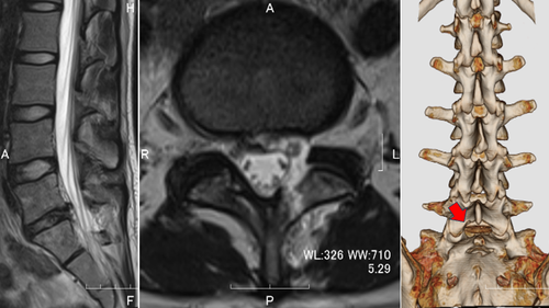 術後MRI
