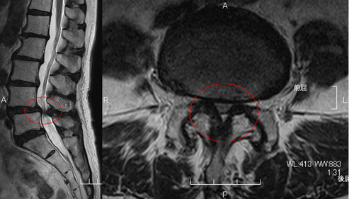 術前MRI