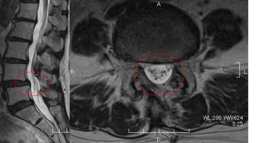 術後MRI