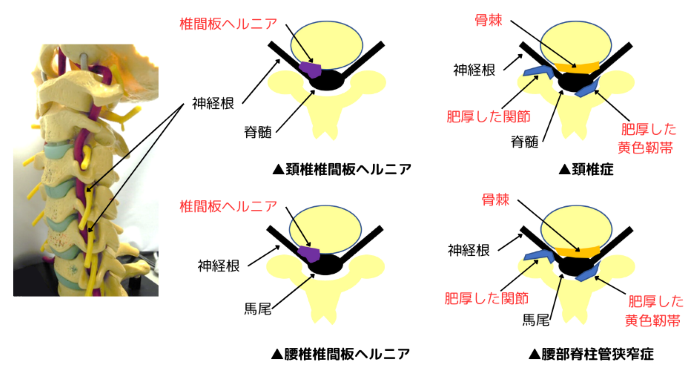 頚椎症、頚椎ヘルニア、腰部脊柱管狭窄症、腰椎へルニアの図